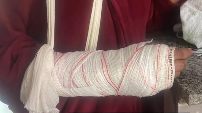 Manicure tem braço quebrado durante agressão e pede medida protetiva contra sobrinho na Grande BH