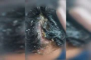 Couro cabeludo da criança com larvas