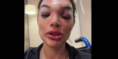 A cirurgi&atilde;-dentista Giullia Falc&atilde;o afirma ter sido agredida pelo marido, o empres&aacute;rio Ivo Kos. Foto: Reprodu&ccedil;&atilde;o/@dragiufalcao via TikTok / Estad&atilde;o