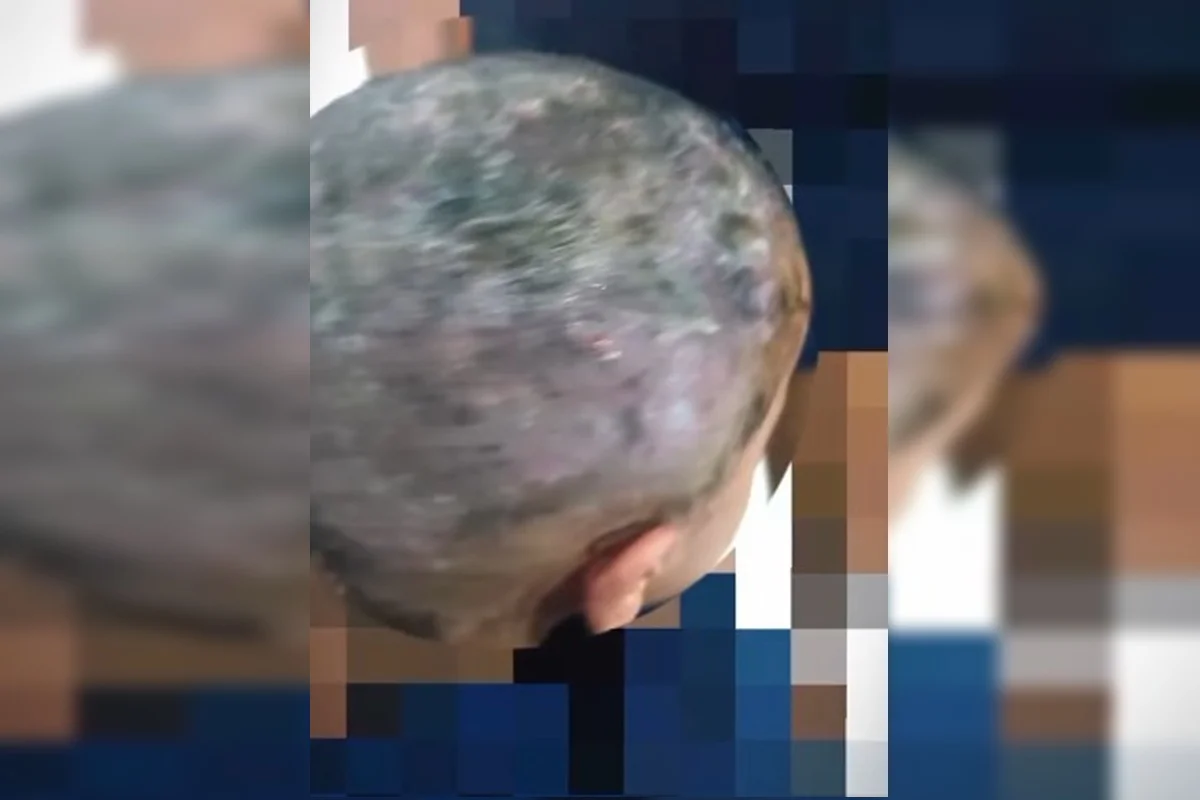 Larvas na cabeça: pais são presos por suspeita de maus-tratos e negligência